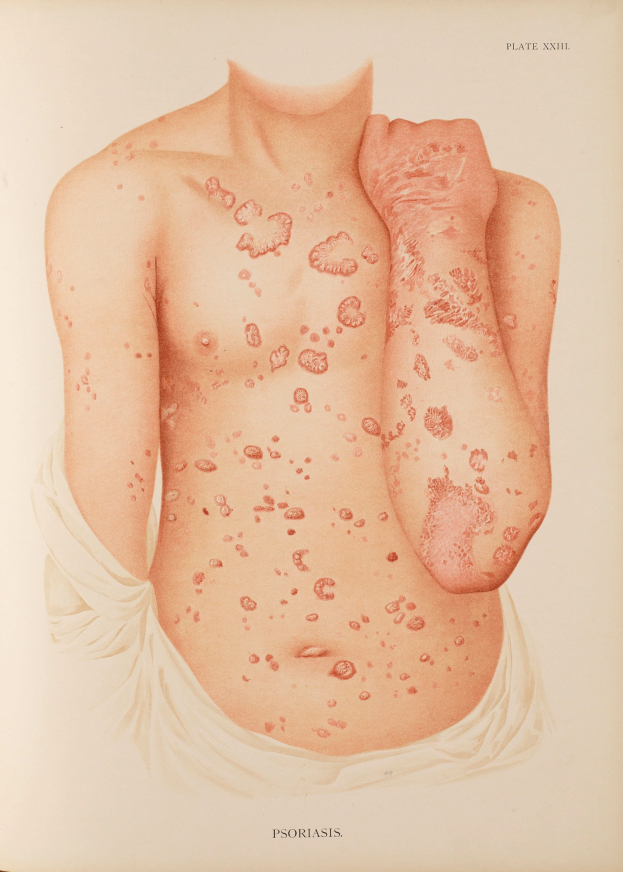 Ein Buchumschlag mit einer Illustration eines Mannes, der rote Punkte hat, die wahrscheinlich Psoriasis darstellen, neben Text über die Erkrankung.